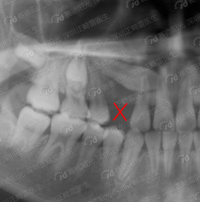 乳牙早失，恒牙失去引导导致萌出方向异常.jpg