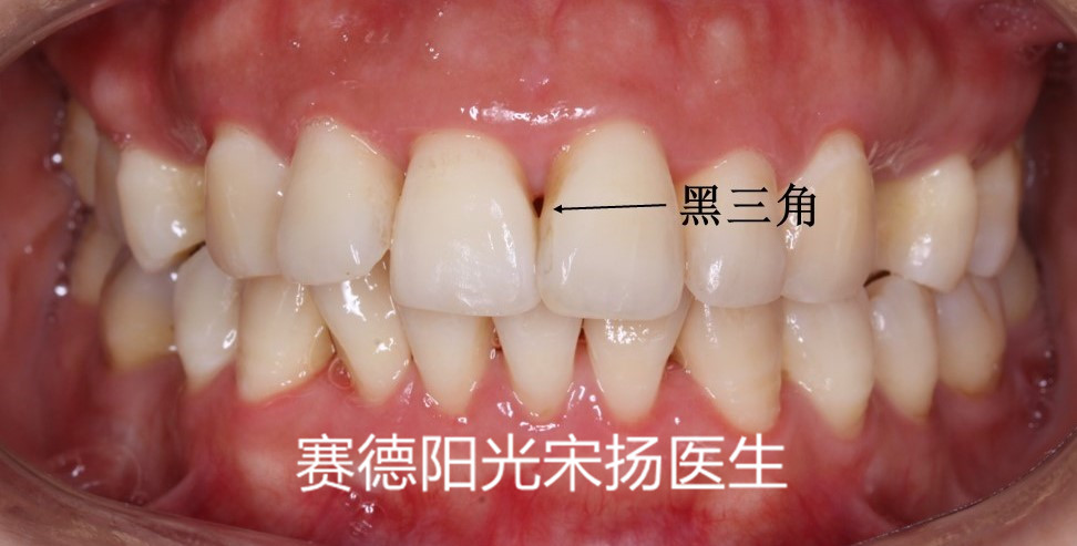 尊龙凯时阳光口腔宋扬医生牙齿黑三角科普图片