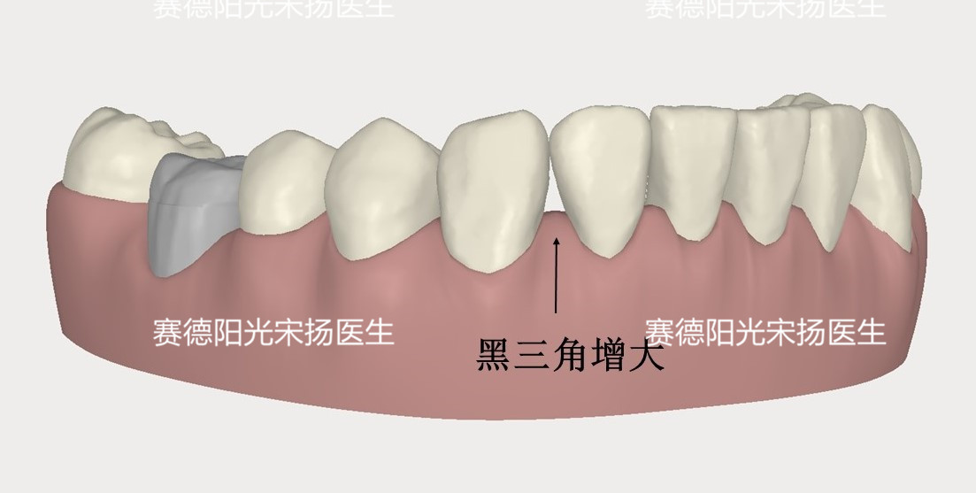 尊龙凯时阳光口腔宋扬医生牙齿黑三角科普图片