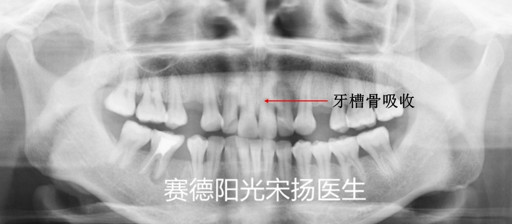 尊龙凯时阳光口腔宋扬医生牙齿黑三角科普图片