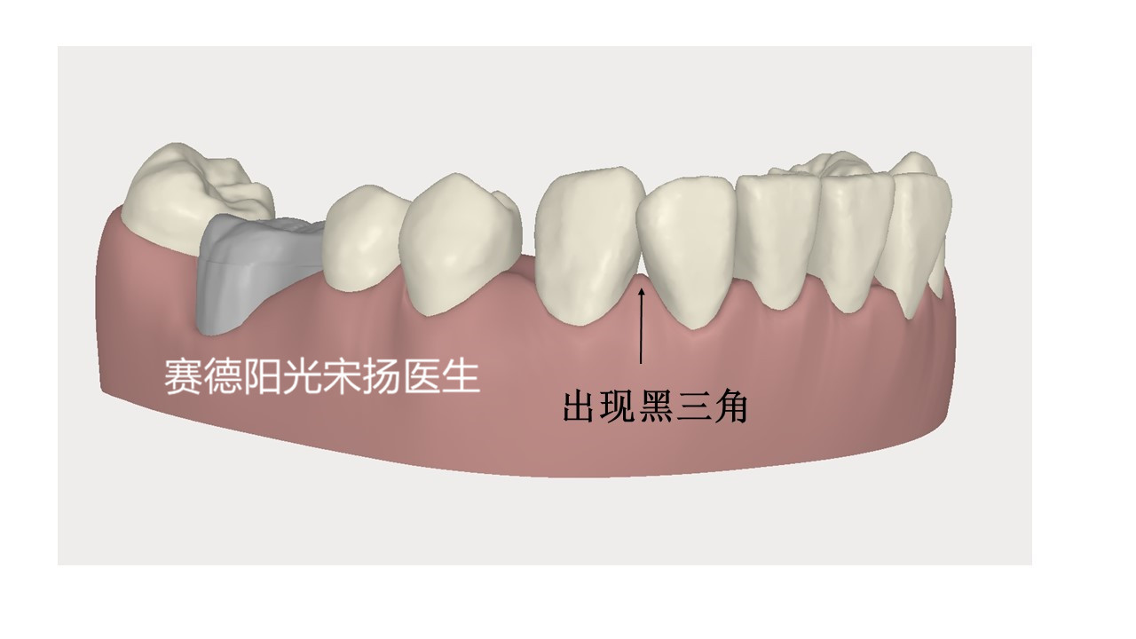 尊龙凯时阳光口腔宋扬医生牙齿黑三角科普图片