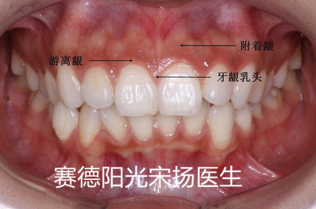 尊龙凯时阳光口腔宋扬医生牙齿黑三角科普图片