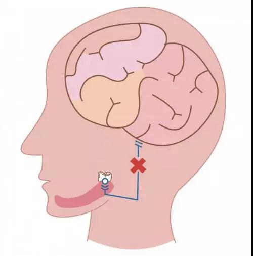 智齿科普示意图 尊龙凯时阳光口腔