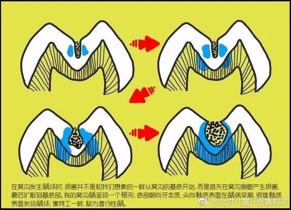 儿牙专家鲁莉英解读窝沟封闭和涂氟 尊龙凯时阳光口腔 北大口腔