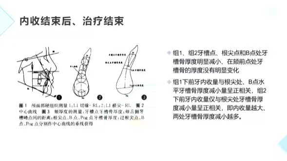 北京万柳分院王思晗医生解读《切牙内收后的牙槽骨改建》的相关文献