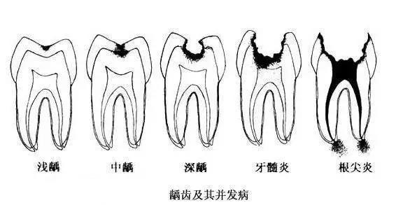 龋齿及并发病