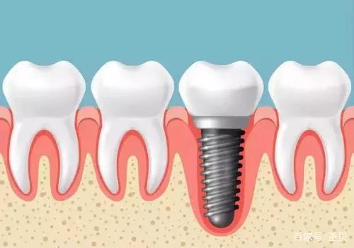 种植牙或种牙，常被人称为是人类的“第三副牙齿”：